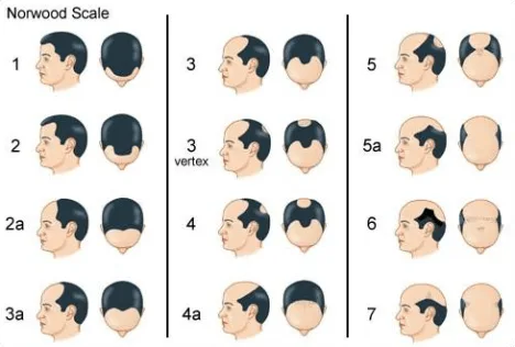 Nordwood scale: 7 fasen van haaruitval bij mannen.