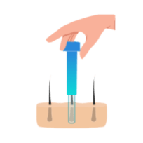 Infographic implanteren grafts met de Choi pen.