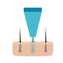 Infographic incisies maken rondom de haarzakjes. 