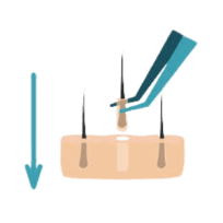 Infographic implanteren grafts met de Choi pen.