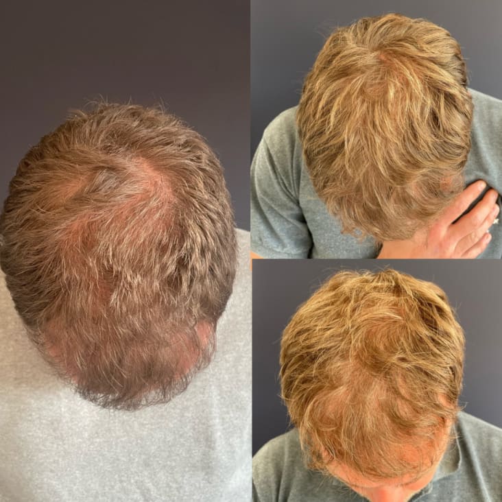 De resultaten van het haargroei stimuleren na haartransplantatie, verschillende methodes.