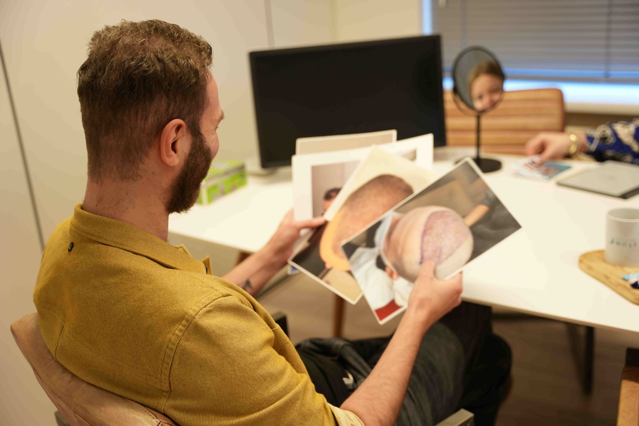 Haargroei stimuleren na haartransplantatie