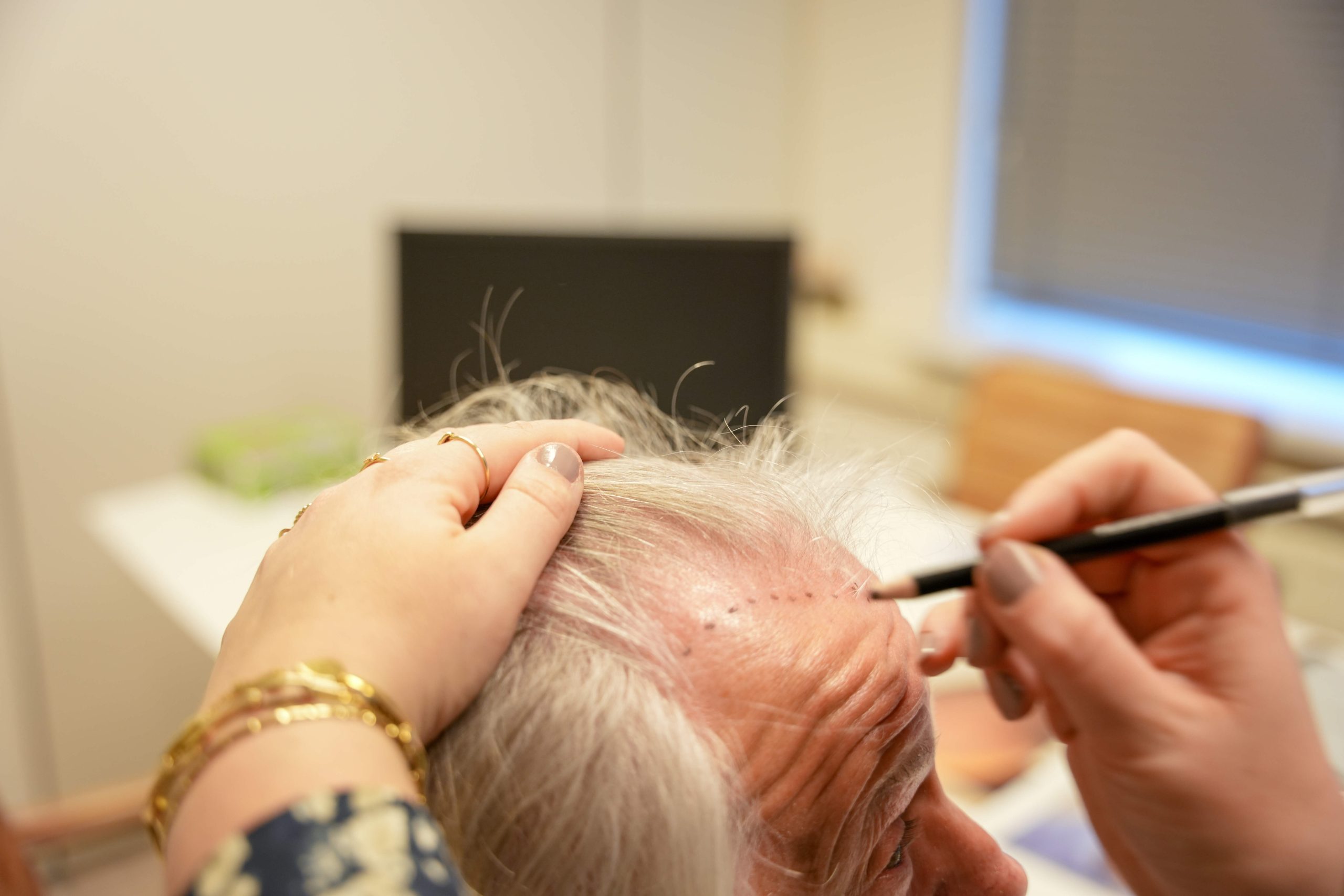 Wat is een haartransplantatie?