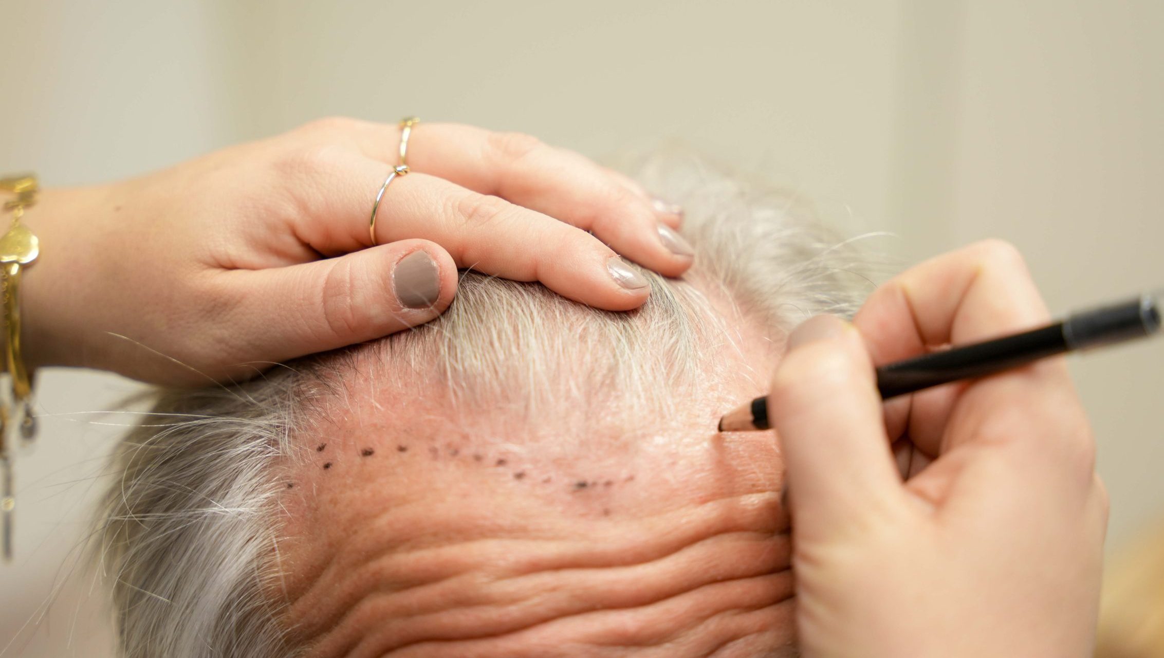 Haartransplantatie zonder scheren