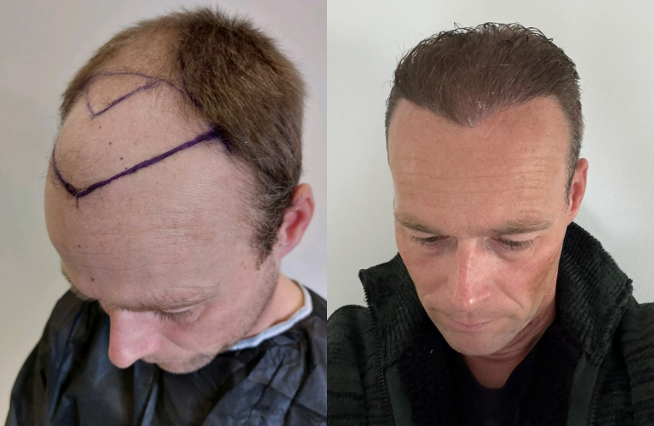 voor-en-na-foto-haartransplantatie Voor en na foto haartransplantatie man