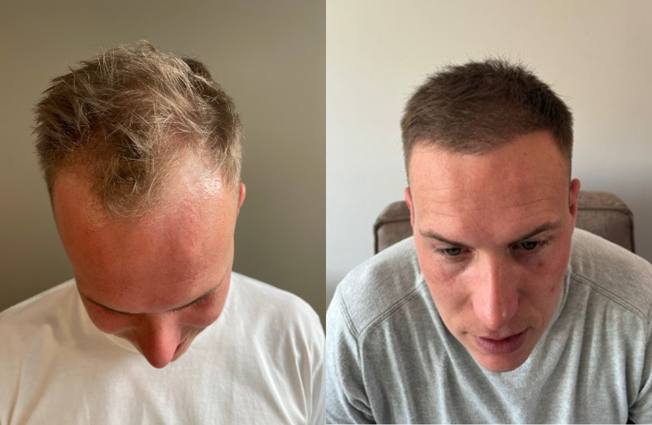 voor-en-na-foto-haartransplantatie Voor en na foto haartransplantatie man