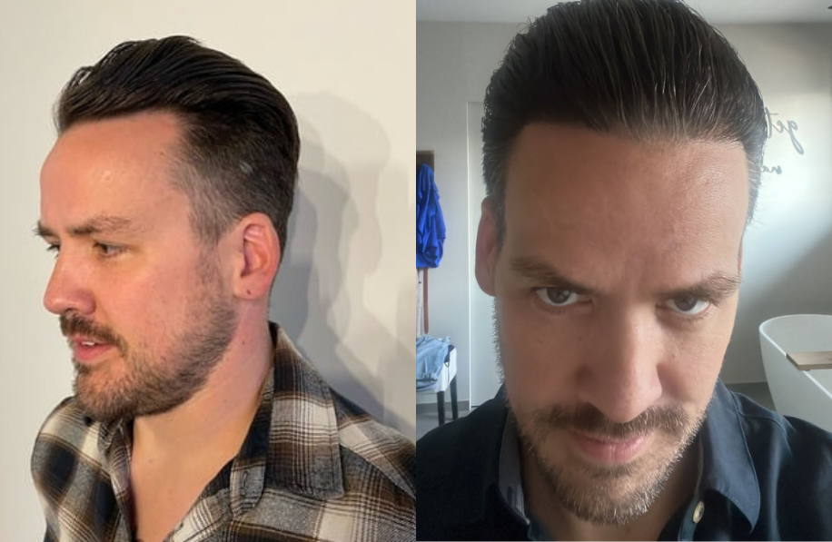 voor-en-na-foto-haartransplantatie Voor en na foto haartransplantatie man