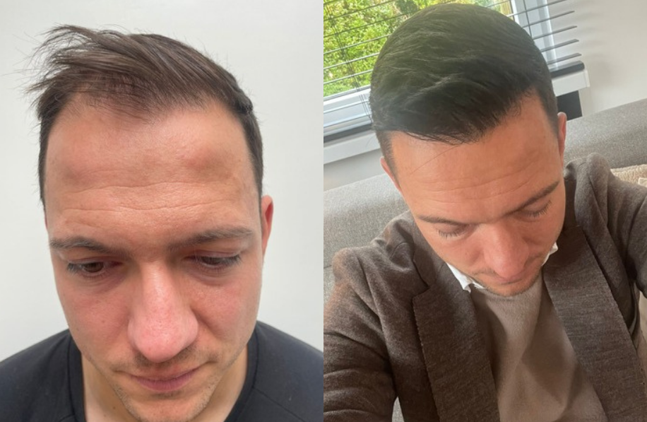 voor-en-na-foto-haartransplantatie Voor en na foto haartransplantatie man