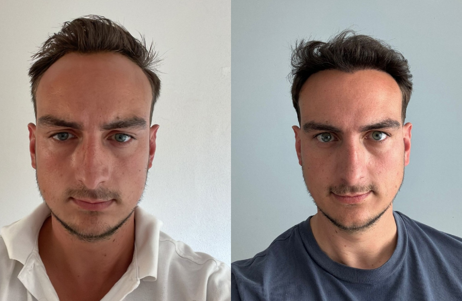 voor-en-na-foto-haartransplantatie Voor en na foto haartransplantatie man