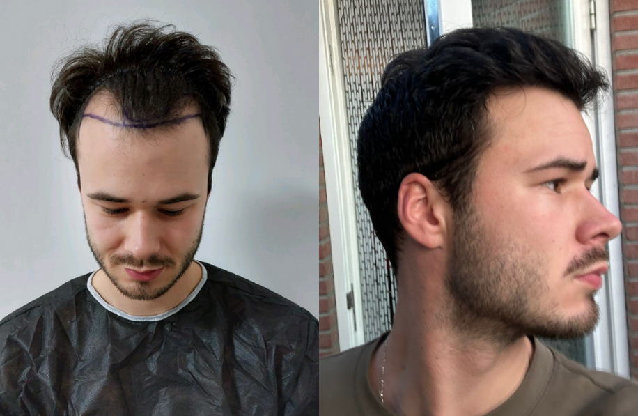 voor-en-na-foto-haartransplantatie Voor en na foto haartransplantatie man