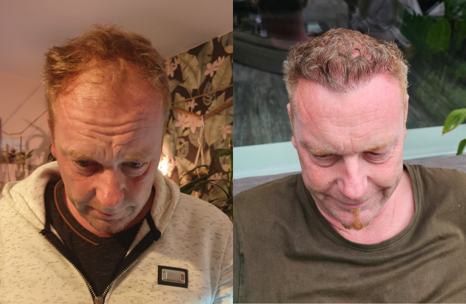 voor-en-na-foto-haartransplantatie Voor en na foto haartransplantatie man