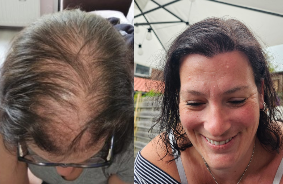 voor-en-na-foto-haartransplantatie Voor en na foto haartransplantatie vrouw
