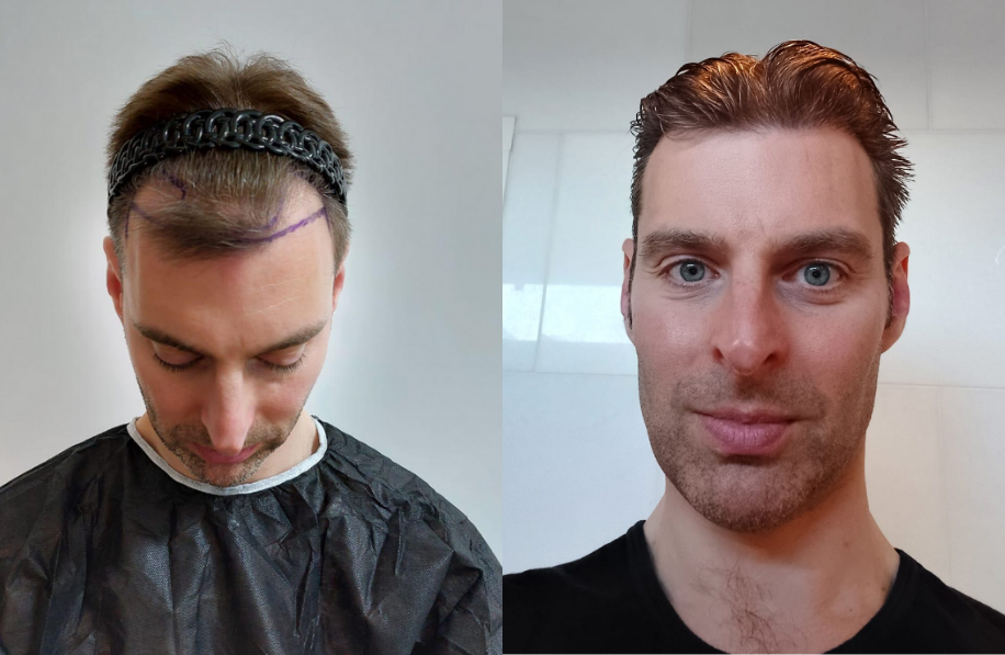 voor-en-na-foto-haartransplantatie Voor en na foto haartransplantatie man