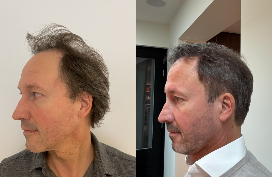 voor-en-na-foto-haartransplantatie Voor en na foto haartransplantatie man