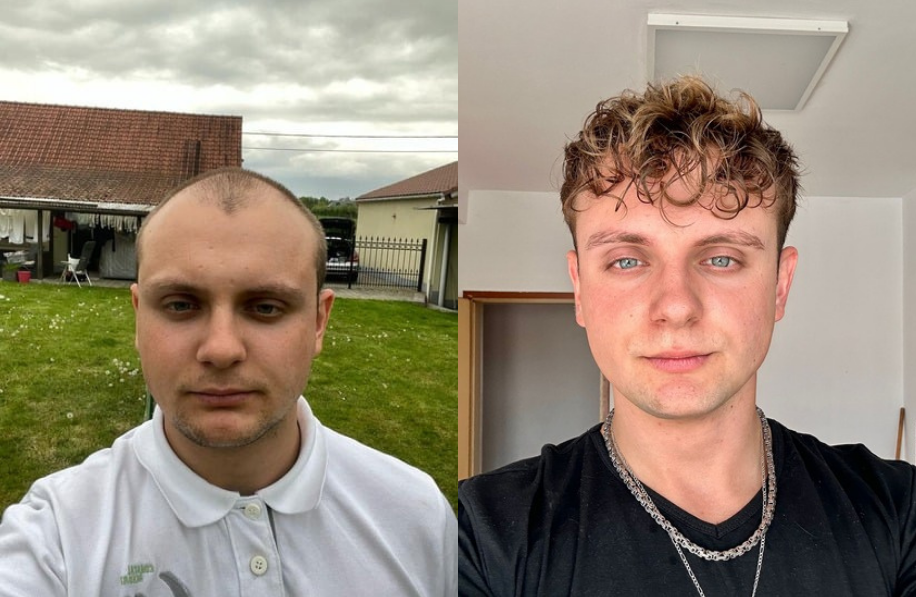 voor-en-na-foto-haartransplantatie Voor en na foto haartransplantatie man